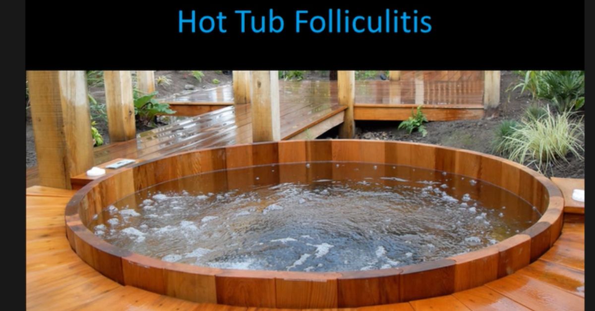 How to Treat Hot Tub Folliculitis and Why Some People Get It